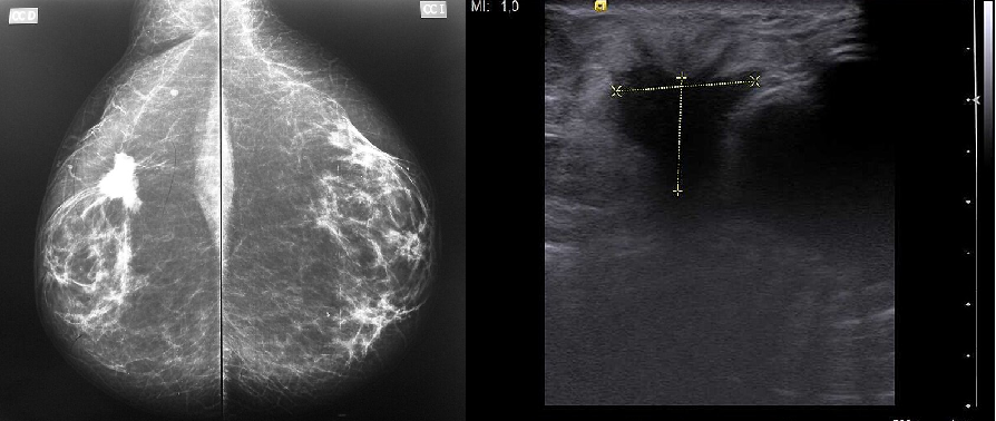 Elizabeth case study — mammogram and ultrasound findings